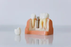 Korony na implantach